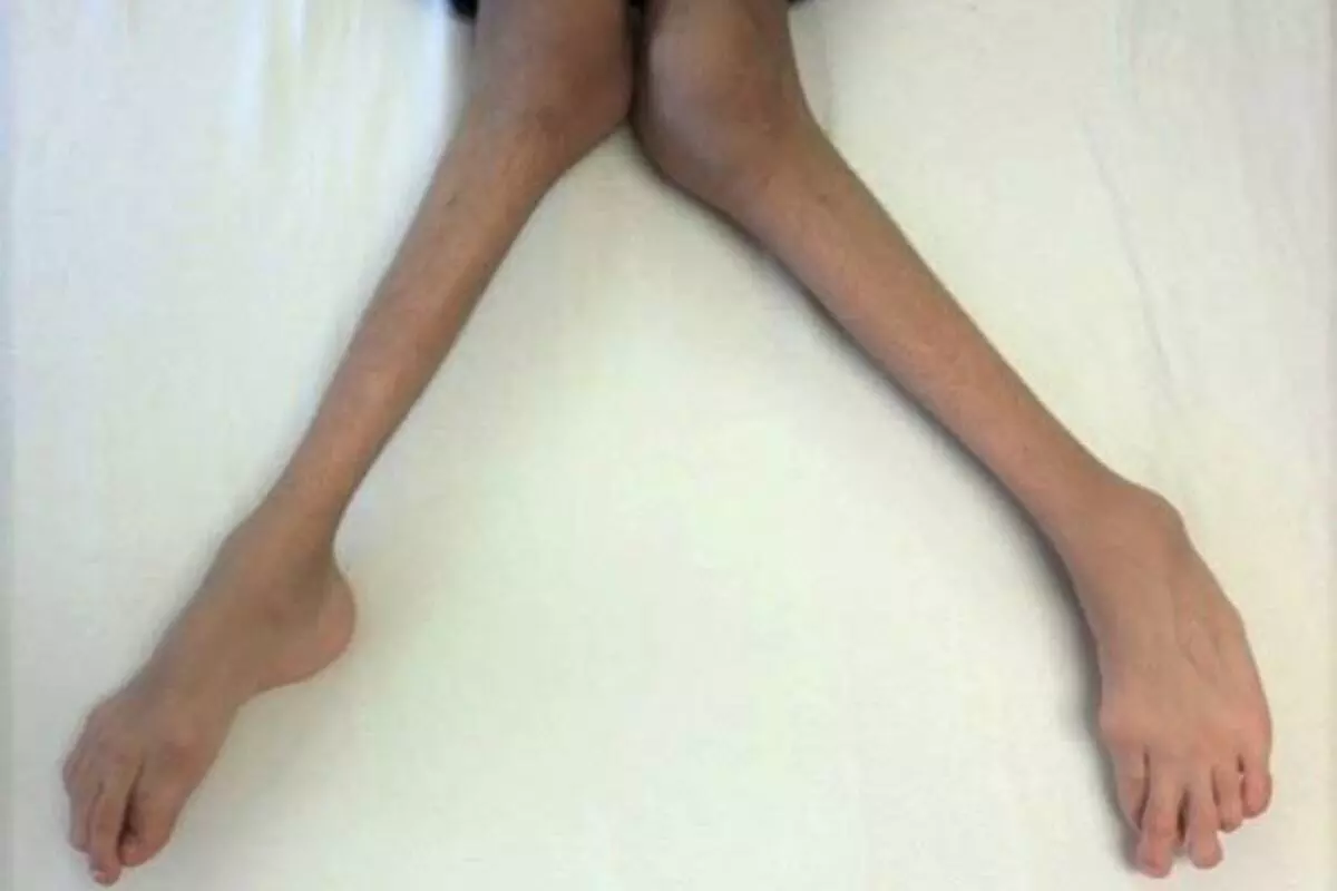 Rickets Disease: अपने बच्चों को घर में बंद रखने की न करें गलती, धूप की कमी  से हो सकती है ये बीमारी