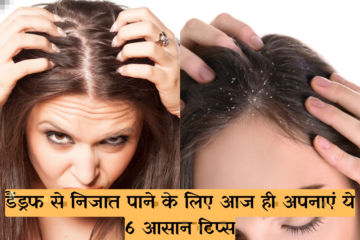 How to get rid of Dandruff Follow these 6 easy tips today to get rid