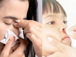 Nose bleeding