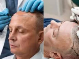 hair transplant