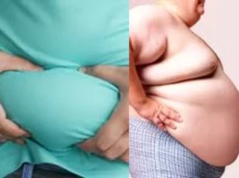 obesity