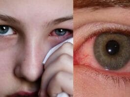 Eye Flu