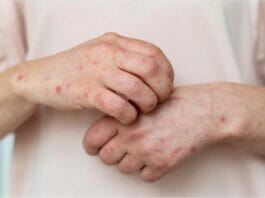 Skin Allergy