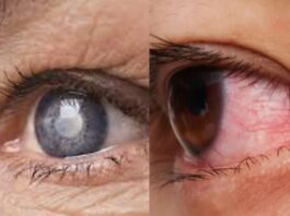 Eye Diseases