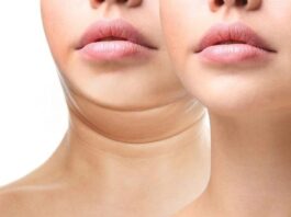 Face Fat Causes