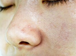 oily skin