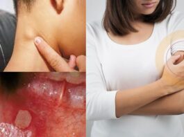 HIV Symptoms