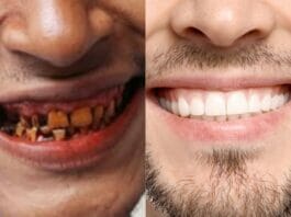 How to clean teeth