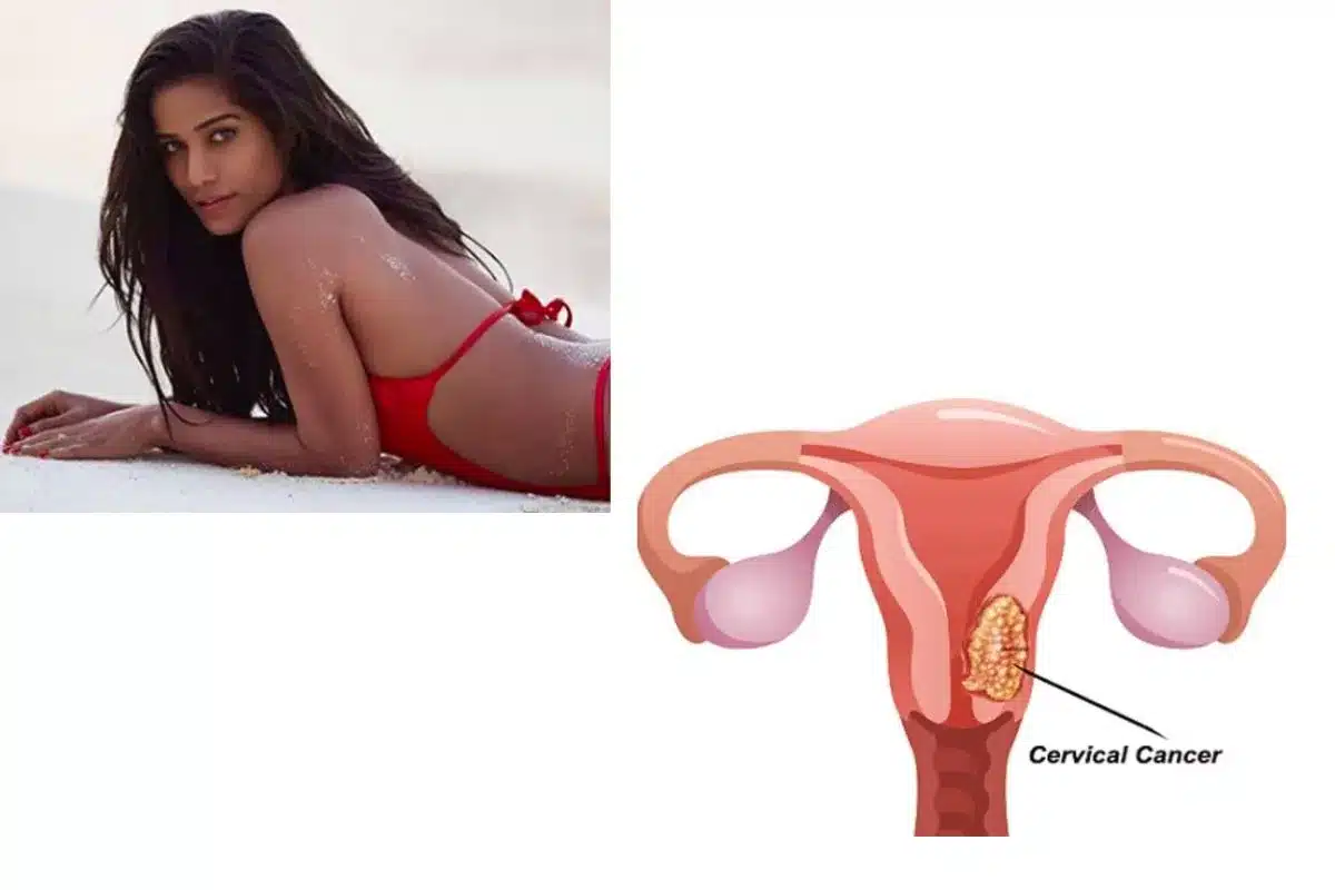 Cervical Cancer