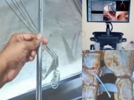 Bronchoscopy