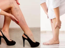 Varicose Veins