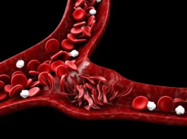 World Sickle Cell Day 2024