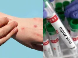 Mpox In India