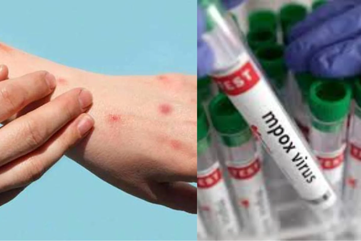 Mpox In India Mpox In India
