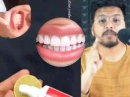 Teeth Whitening