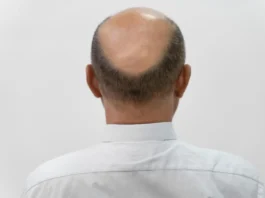 Hair Loss Treatment