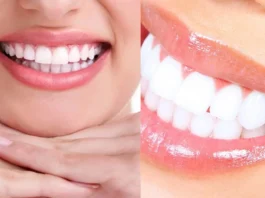 Teeth whitening