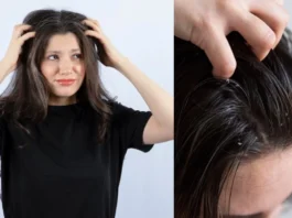 How to get rid of Dandruff