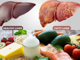 Fatty Liver