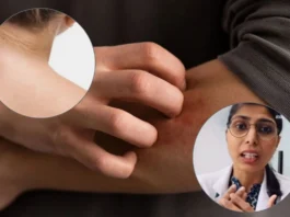 Skin Diseases