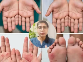 HFMD Virus