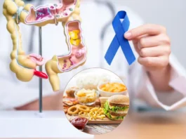 Colorectal Cancer