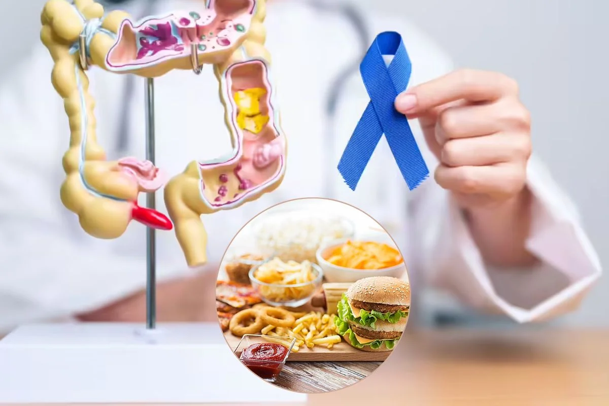 Colorectal Cancer Colorectal Cancer