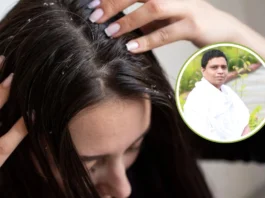 Dandruff Home Remedies
