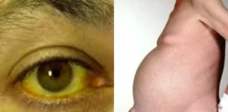 Liver Failure: क्या सच में पीलिया करता है लिवर फेल? जानें लक्षण और बचाव के तरीके Liver Failure