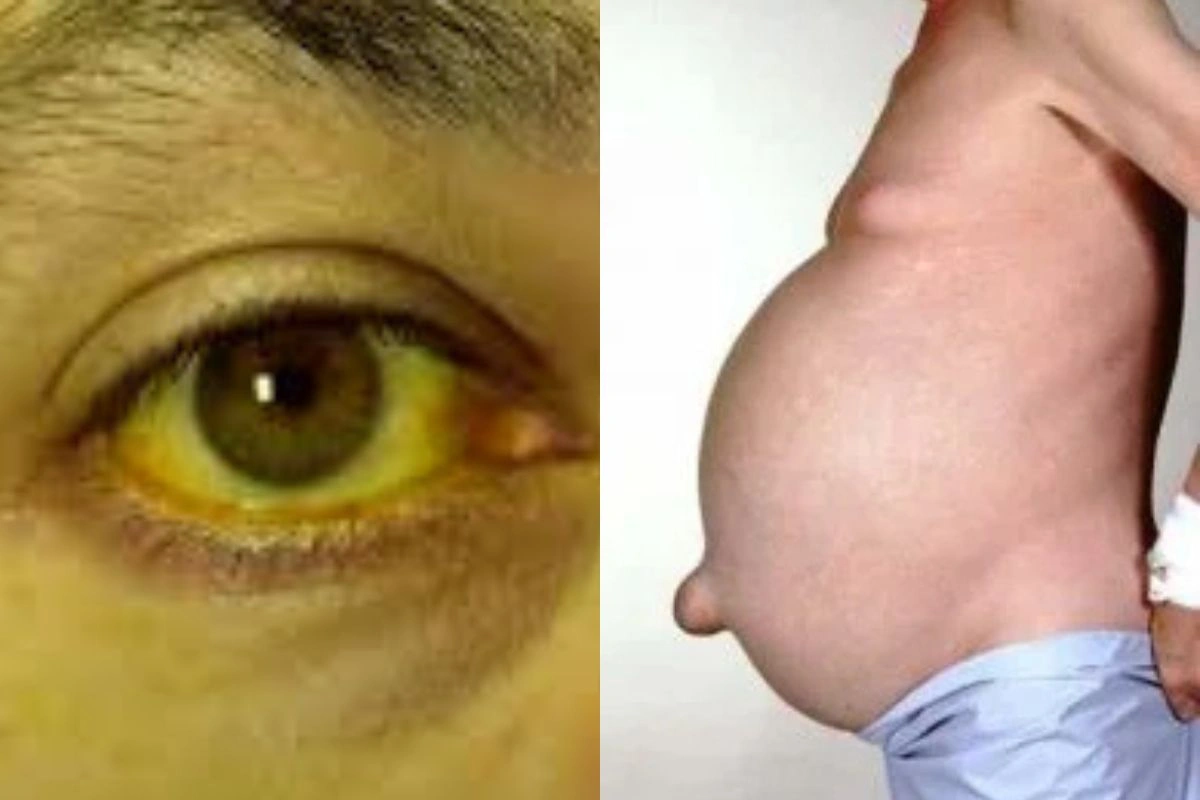 Liver Failure Liver Failure