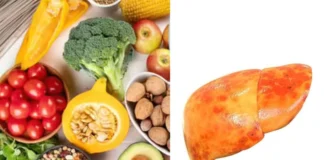 Fatty Liver के मरीजों के लिए काल हैं ये 3 चीजें, भूलकर भी ना खाएं Fatty Liver