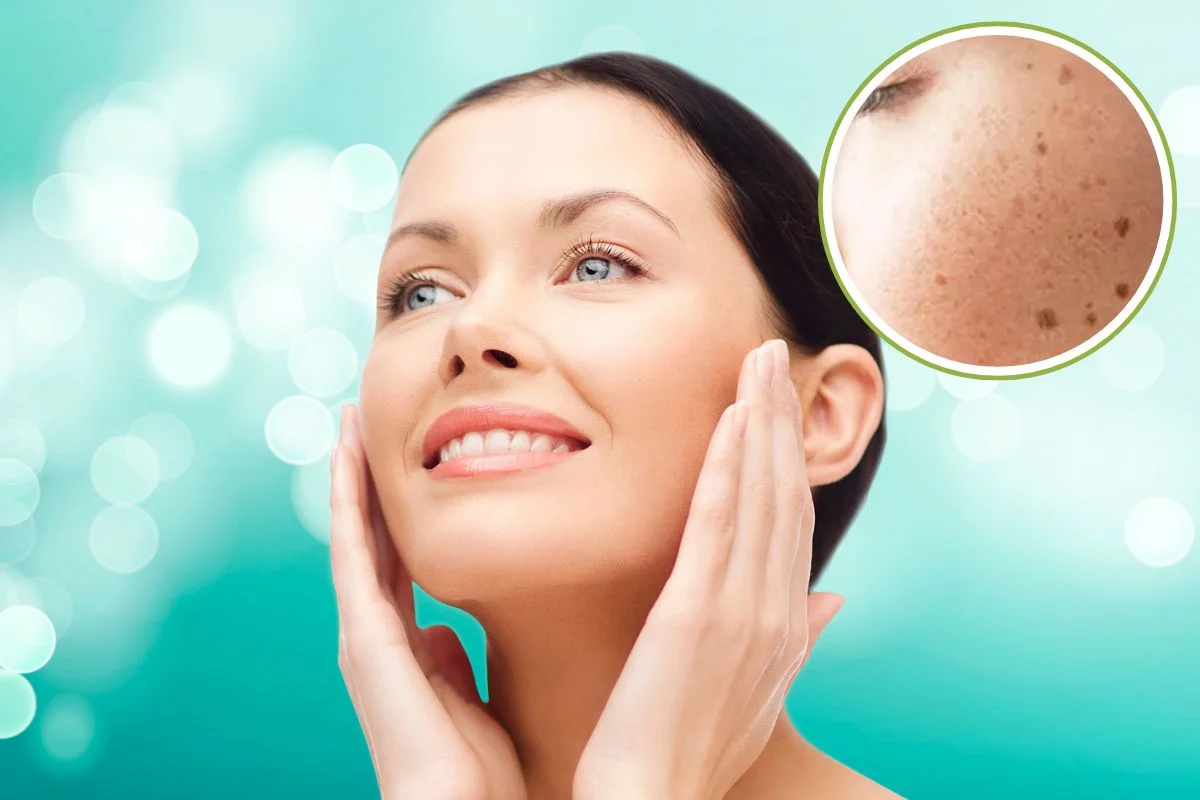 Pigmentation On Face Remedy Pigmentation On Face Remedy