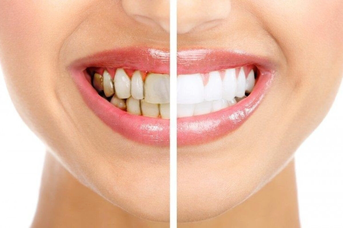 Teeth Health
