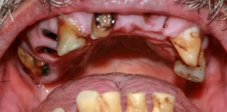 Teeth Health: दांतों की सड़न, खून और दर्द से राहत दिलाएगा ये देसी चूर्ण, बिना दवा पुरानी बीमारी से पाएं राहत Teeth Health
