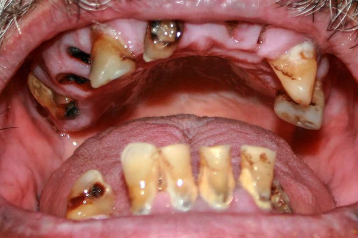 Teeth Health Teeth Health