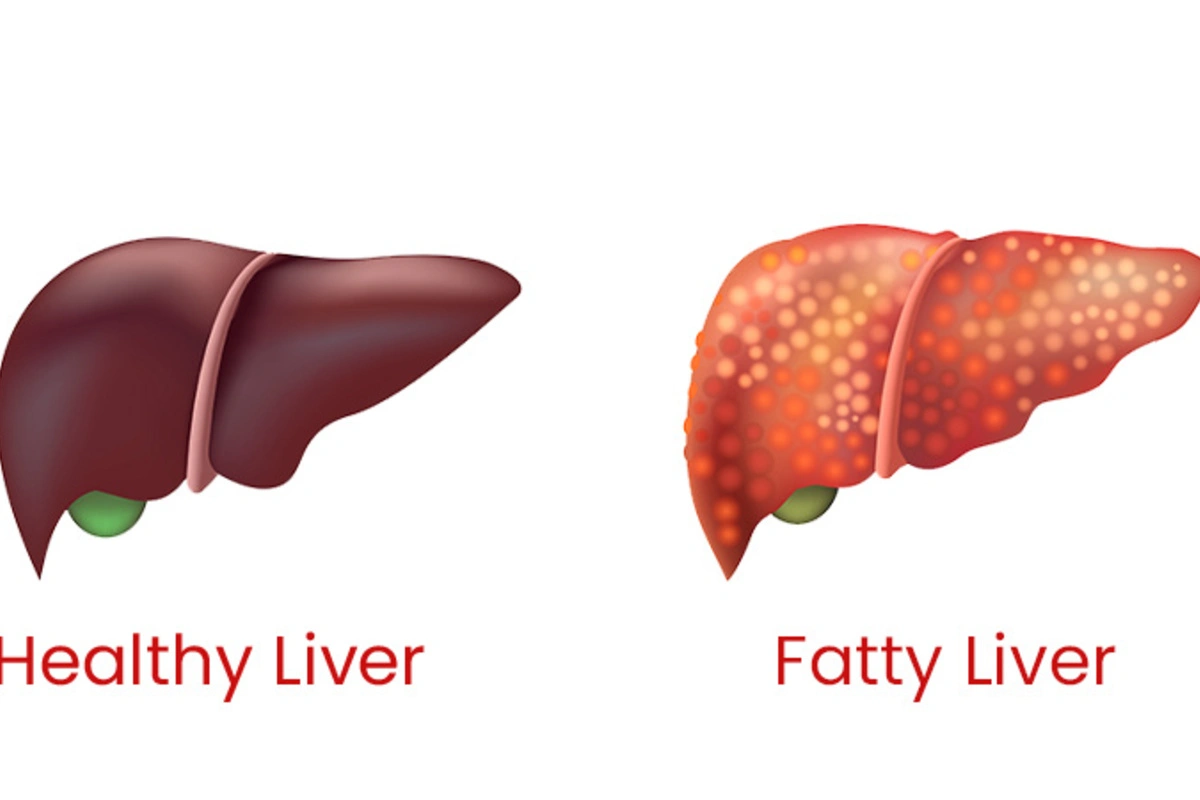 Fatty Liver