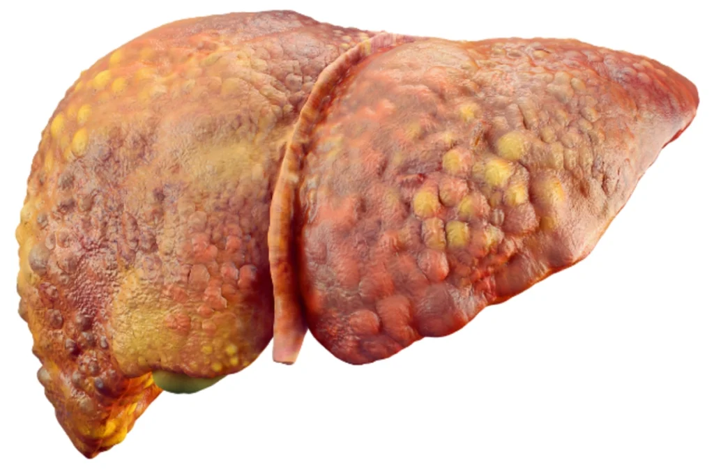 Liver Cirrhosis