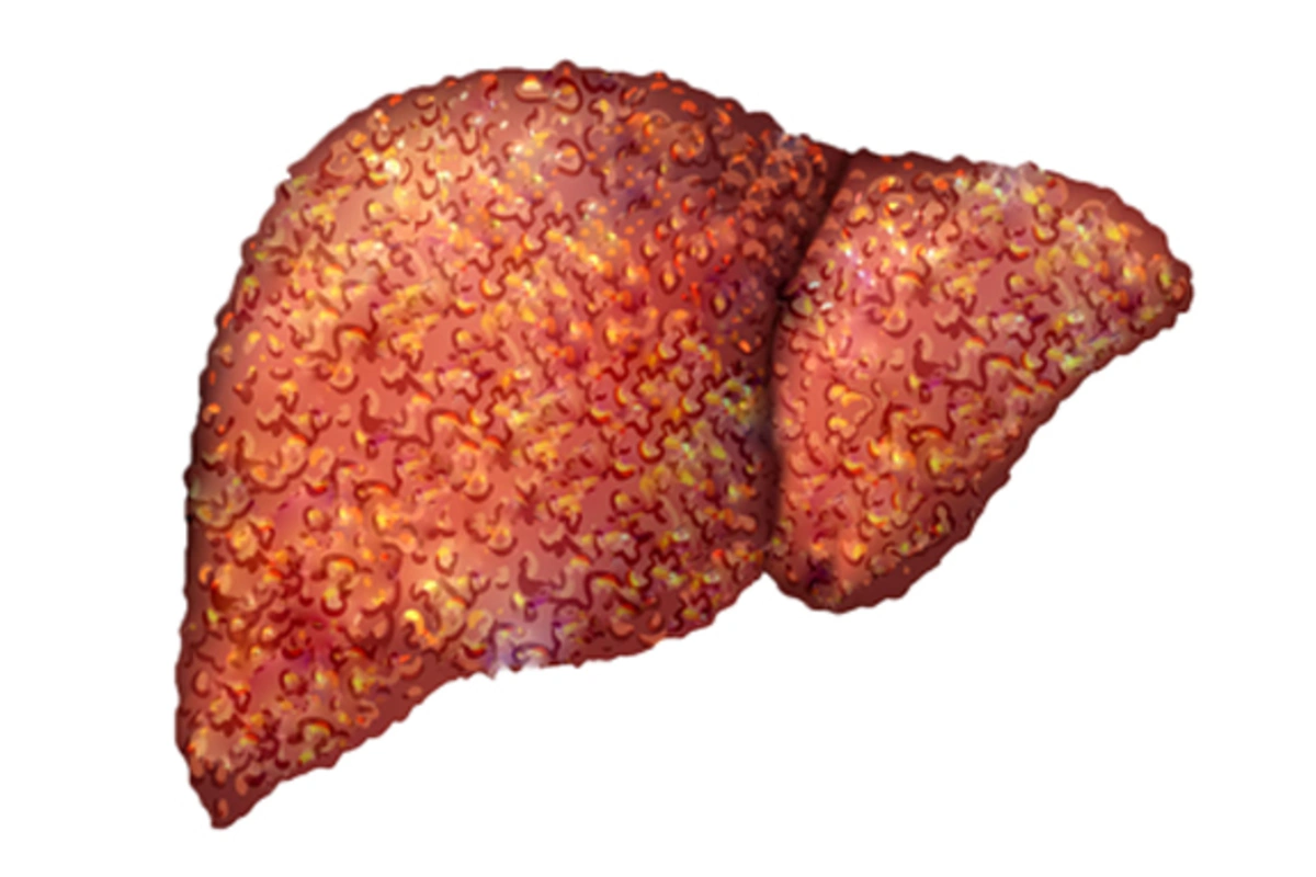 Liver Cirrhosis