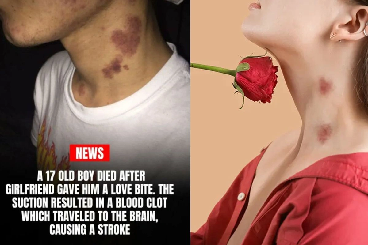 Love Bite Side Effect