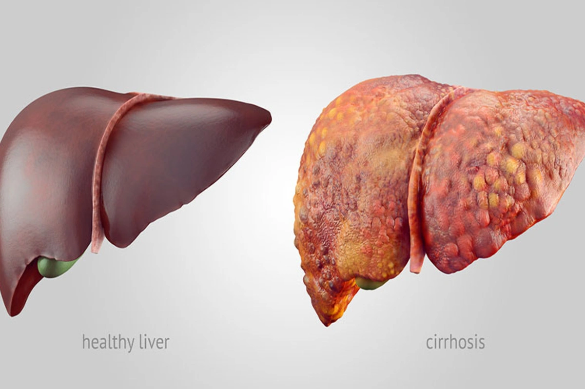 fatty liver