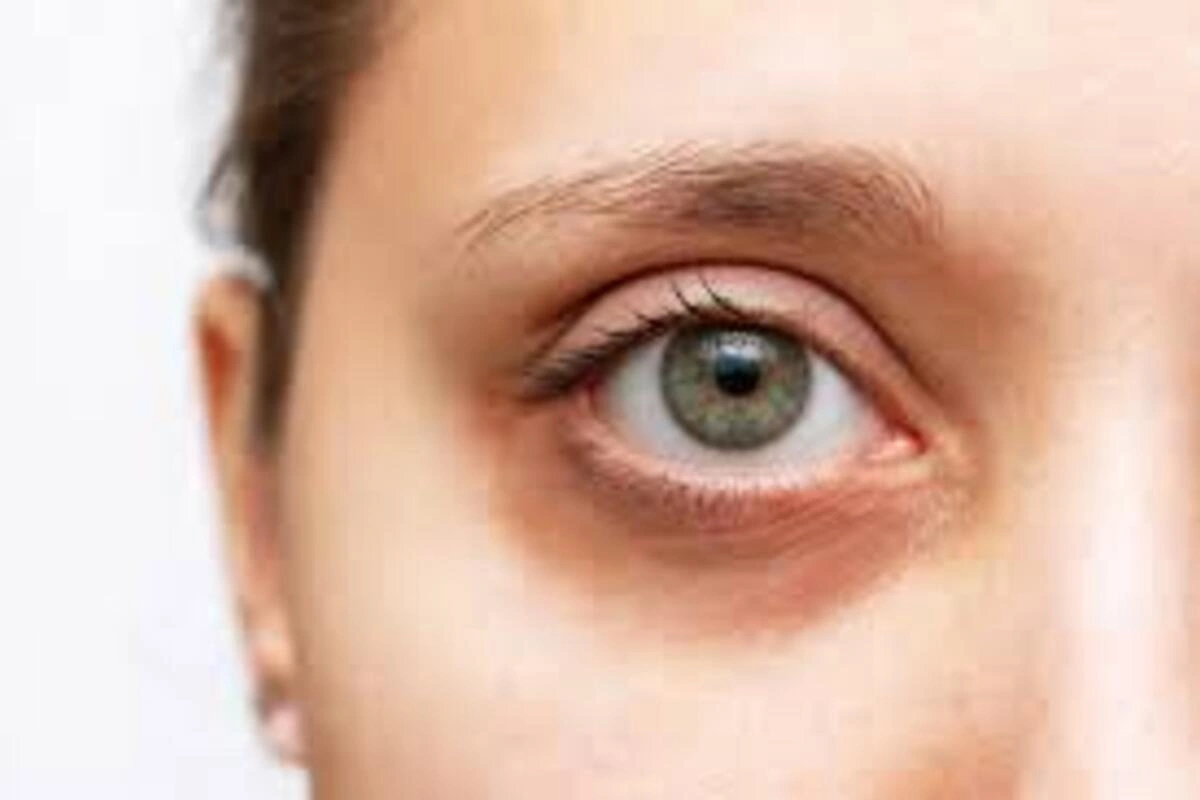 Dark Eye Circles