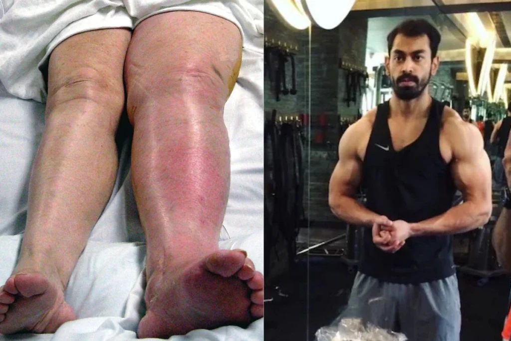 Deep Vein Thrombosis