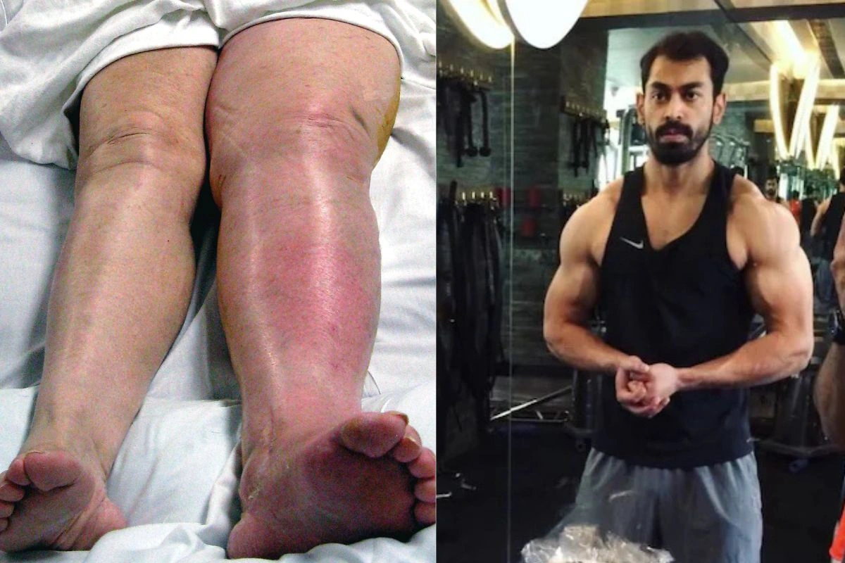Deep Vein Thrombosis