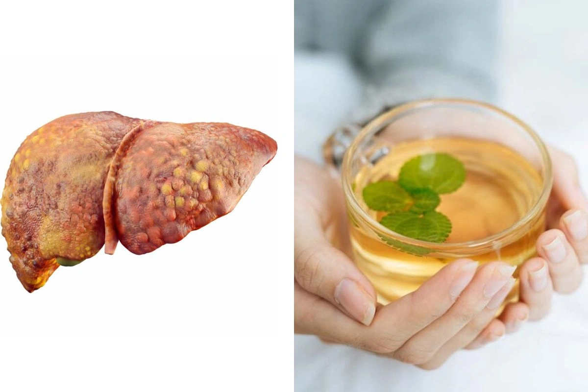Fatty Liver