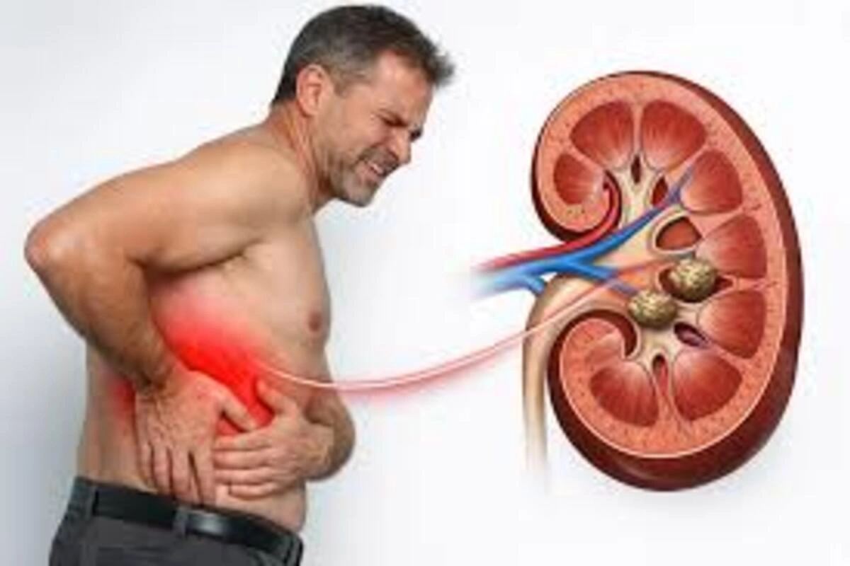 Kidney Stone
