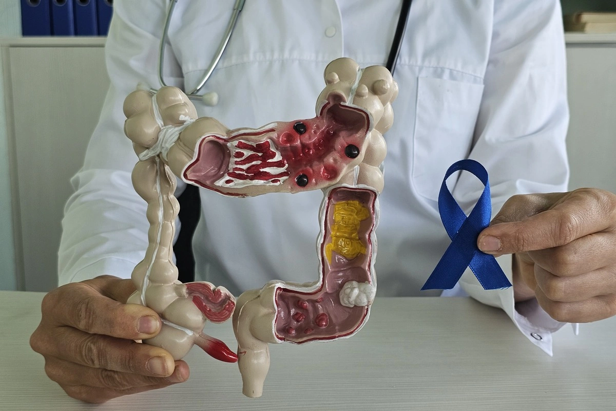 Colon Cancer