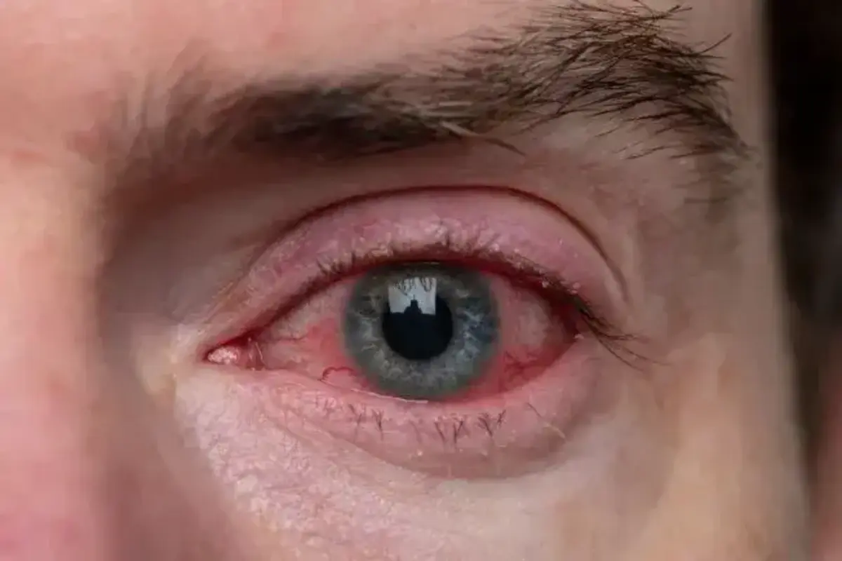 Eye Flu