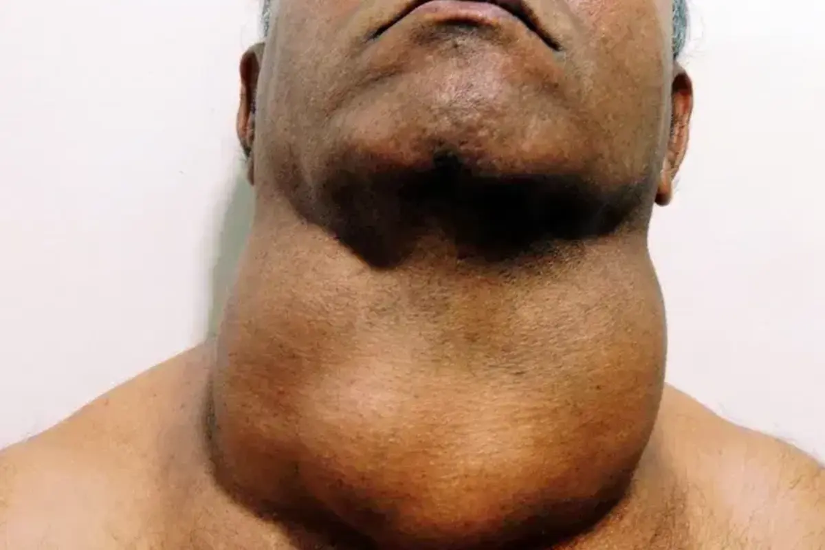 Goiter