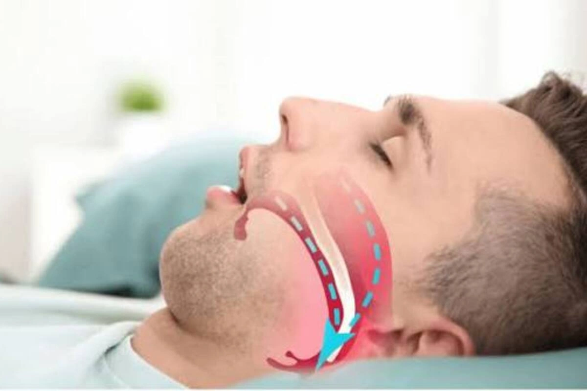 Sleep Apnea