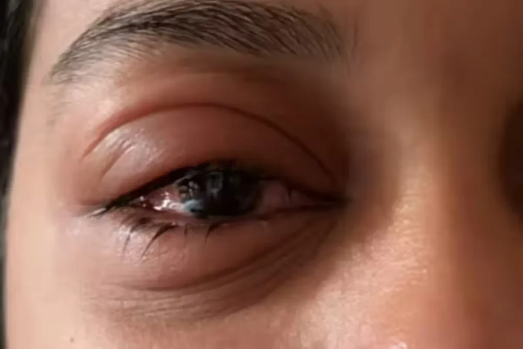 Eye Health